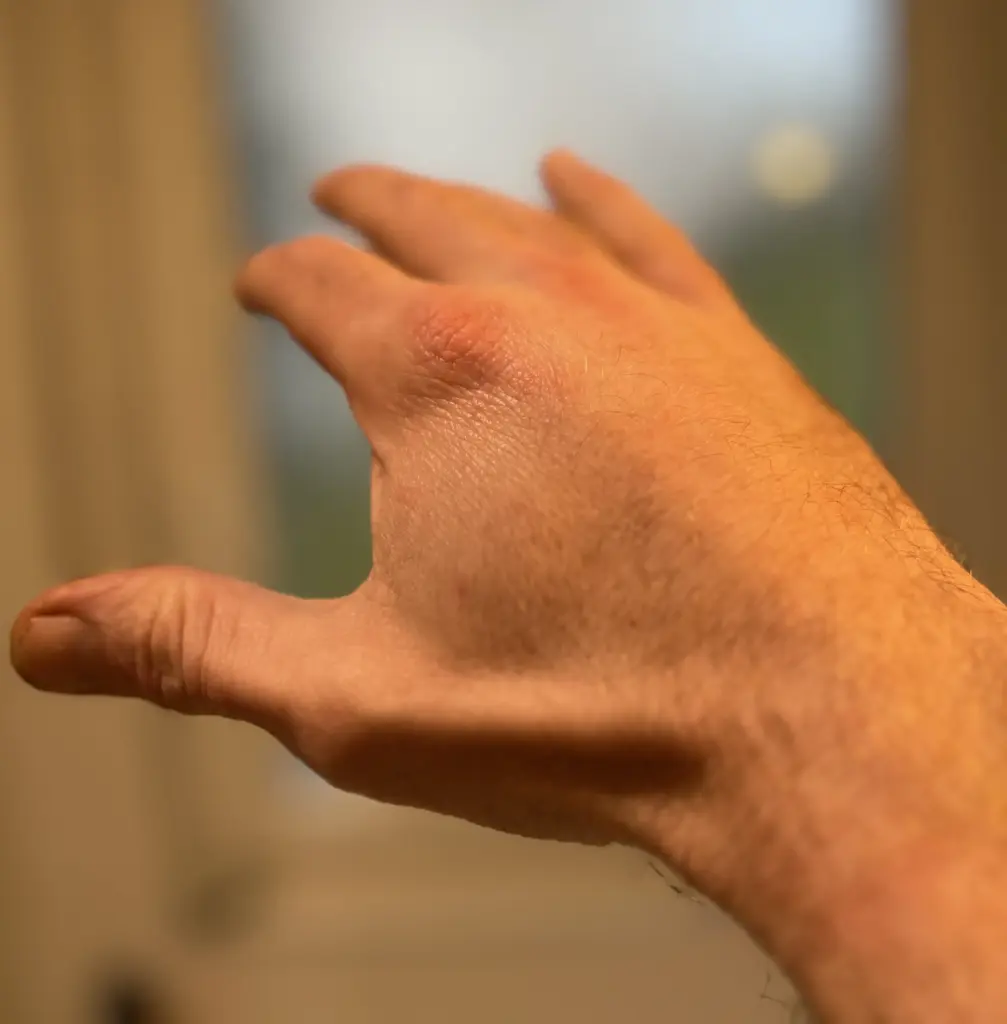 der erste Bienenstich des Jahres ging in den Handrücken